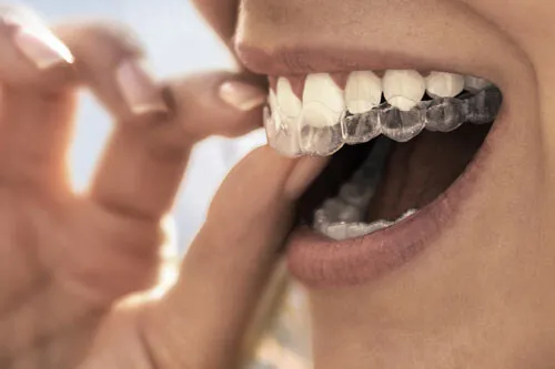 aparelho ortodôntico Invisalign